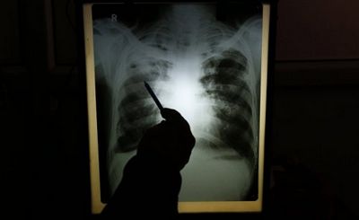 Возвращение белой смерти: угроза возникновения новых штаммов туберкулеза - «наука»